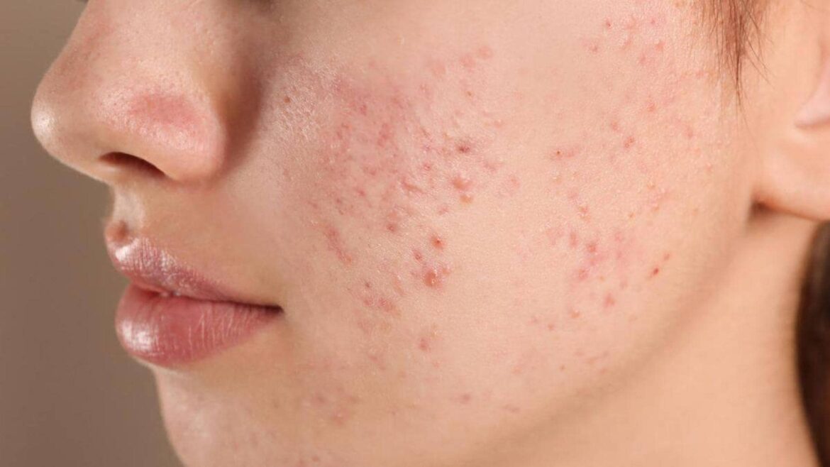 ¿Influye la alimentación en la aparición del acné? Un dermatólogo aclara si es cierta esta creencia