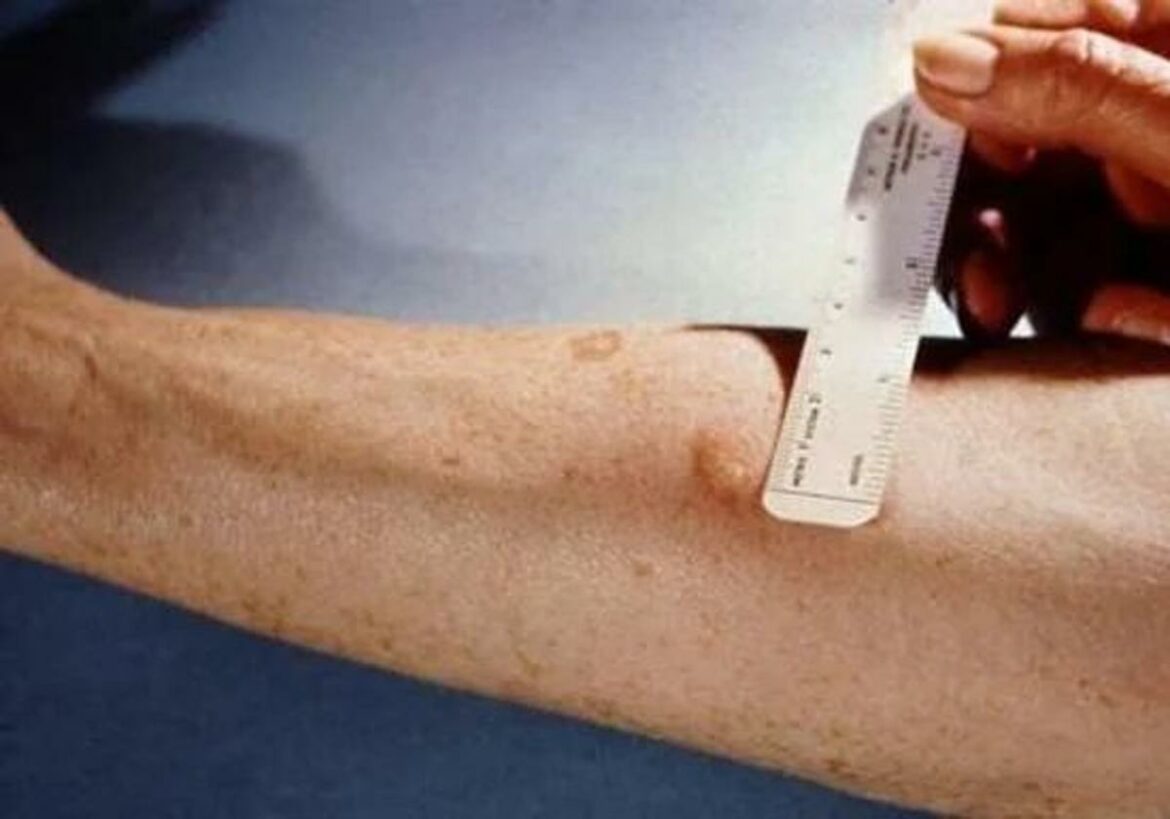 La incidencia de tuberculosis es la más baja de los últimos diez años