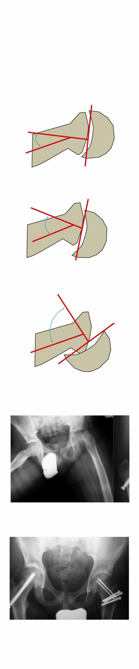 La lesión en la cadera que se dispara por la obesidad infantil: «Nos llegan cuando ya no pueden ni caminar»